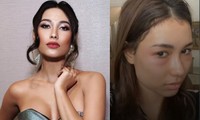 Hoa hậu Hoàn vũ Indonesia khổ sở vì bỏng mặt hậu thẩm mỹ