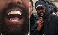 Kanye West gây sốc khi nhổ hết răng thật