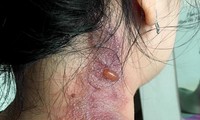 Nhiều bệnh nhân COVID-19 bị kiến ba khoang &apos;tấn công&apos;
