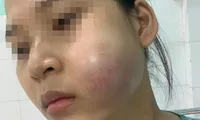 Bỏ tiền triệu &apos;nâng cấp sắc đẹp&apos;, thiếu nữ &apos;nhận&apos; về gương mặt biến dạng 