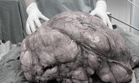Người đàn ông ở TPHCM mang &apos;bụng bầu&apos; nặng gần 18kg