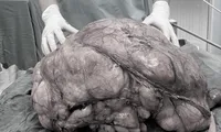 Người đàn ông ở TPHCM mang &apos;bụng bầu&apos; nặng gần 18kg