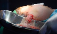 Nghe lời chiêu dụ tiêm filler để trẻ hóa, cô gái bị hoại tử mặt