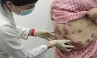 Quý bà &apos;tan nát&apos; cơ thể vì mê làm đẹp cấp tốc