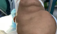 Cứu nữ bệnh nhân nhiều năm bị khối bướu &apos;bóp cổ&apos;