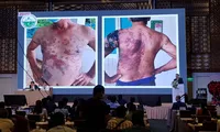 Những dấu hiệu trên da cảnh báo bệnh lý ác tính