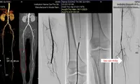 Tắc mạch máu khiến nữ bệnh nhân suýt cụt chân