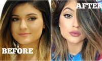 Tại sao mọi người đều tiêm filler làm đầy môi? Những khao khát dấu đằng sau mốt môi dày