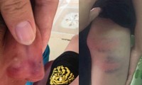 Cô giáo nghi đánh con riêng của chồng nhập viện