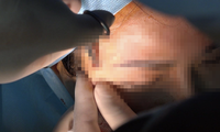 Cơ sở spa &apos;tiêm hộ&apos; filler vào ngực và bụng khiến một phụ nữ nguy kịch, phải chạy ECMO?