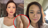 Loạt ảnh Sam &quot;tả tơi&quot; trên phim trường khiến fan xót xa: Chân bầm tím, mặt sưng phù