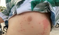 Nhiều người bị sứa lửa 'tấn công' khi tắm biển Nha Trang