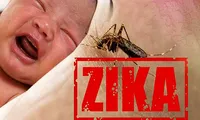 Virus Zika do muỗi truyền liên quan bệnh đầu nhỏ, viêm não tủy cấp, Guillain-Barre. Ảnh: Getty Images