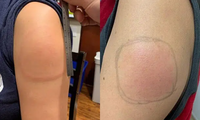 Tại sao nhiều người xuất hiện triệu chứng &apos;cánh tay COVID&apos; sau khi tiêm vaccine?