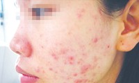 Một nạn nhân của dị ứng mỹ phẩm