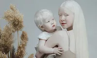 Diện mạo khác lạ của hai chị em người Kazakhstan bị bạch tạng gây &apos;sốt&apos;