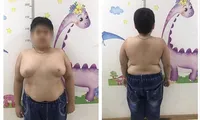Bé trai 13 tuổi tăng cân mất kiểm soát sau khi lạm dụng thuốc corticoid Ảnh: T.Hà 