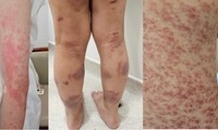 Những lầm tưởng 'chết người' khi tự chữa bệnh miễn dịch, dị ứng tại nhà