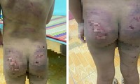 Điều tra nghi án bé gái 7 tuổi nghi bị bạo hành