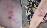 Vụ bé trai nghi bị cha mẹ đánh đập dã man: Cháu bé bị gãy biến dạng cánh tay, bỏng độ 1-2 