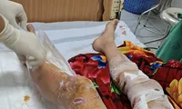 Lào Cai: Nam sinh bị chó thả rông cắn gây thương tích nặng