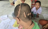 Xót xa gia cảnh bé trai 11 tuổi bị tai nạn giao thông, 7 lần mổ sọ giành lại sự sống