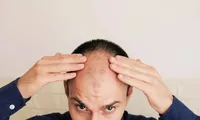 Tại sao đàn ông hay bị hói ở đỉnh đầu và cách chữa trị