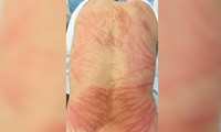 Người đàn ông bị viêm da do ăn nấm hương 