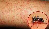 TT-Huế có trường hợp tử vong đầu tiên do sốt xuất huyết, số ca mắc tăng gấp 7 lần