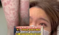 Nhuộm tóc liên tục suốt hai năm, cô gái ở Trung Quốc phải cạo đầu vì suy thận