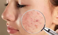 Xác định đúng loại &quot;đèn pin&quot; đang mắc phải sẽ giúp bạn điều trị mụn hiệu quả hơn