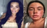 Bắt chước cách chần trứng trong lò vi sóng theo video trên mạng, cô gái bị bỏng khắp mặt
