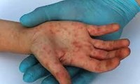 THẾ GIỚI 24H: Châu Âu ghi nhận người chết đầu tiên do đậu mùa khỉ