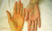 Những dấu hiệu cho thấy gan đang nhiễm độc, cần được &apos;thanh lọc&apos; gấp