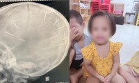 Toàn cảnh vụ bé gái 3 tuổi bị đinh găm vào đầu: Xác định nghi phạm là người tình của mẹ