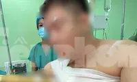 Người đàn ông 39 tuổi bị khúc gỗ keo đâm thủng phổi, gãy 4 xương sườn