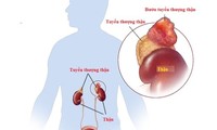 Nguy cơ từ u tuyến thượng thận: Người trẻ tăng huyết áp không rõ nguyên nhân cần cảnh giác