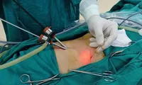 Người phụ nữ nguy kịch vì viên sỏi mật bé xíu &apos;trở chứng&apos; dù sống chung nhiều năm qua