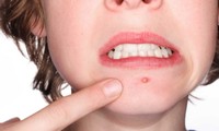 Khoa học chứng minh: Người bị mụn trứng cá thường có điểm số cao và thành công