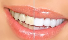 Cách làm trắng răng tại nhà trong 2 phút