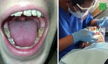 Nghiện nước tăng lực, chàng trai bị mục nát hàm răng