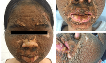 Mặt cô gái sùi như vỏ mít do dùng thuốc trắng da