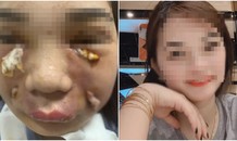 Cô gái ở Hà Nội hoại tử vùng mặt sau tiêm mỡ tự thân