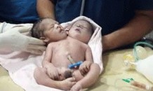 Siêu âm sinh đôi, sản phụ hốt hoảng khi đẻ ra bé trai 2 đầu 3 tay