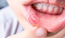 Thủ phạm gây nhiệt miệng
