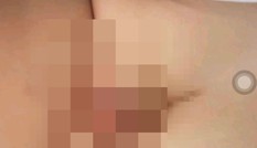 Bé 2 tuổi tổn thương vùng kín khi từ trường mầm non về nhà