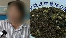Nhịn ăn sáng nhiều năm, bụng người phụ nữ chứa 7.750 viên sỏi mật