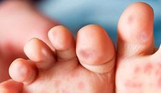 Mách mẹ cách bảo vệ bé yêu trước dịch chân tay miệng đang bùng phát