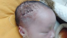 Bé trai mới sinh phải khâu 6 mũi do bác sĩ rạch trúng đầu khi mổ