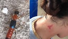 Cách điều trị viêm, bỏng rát da do kiến ba khoang đốt